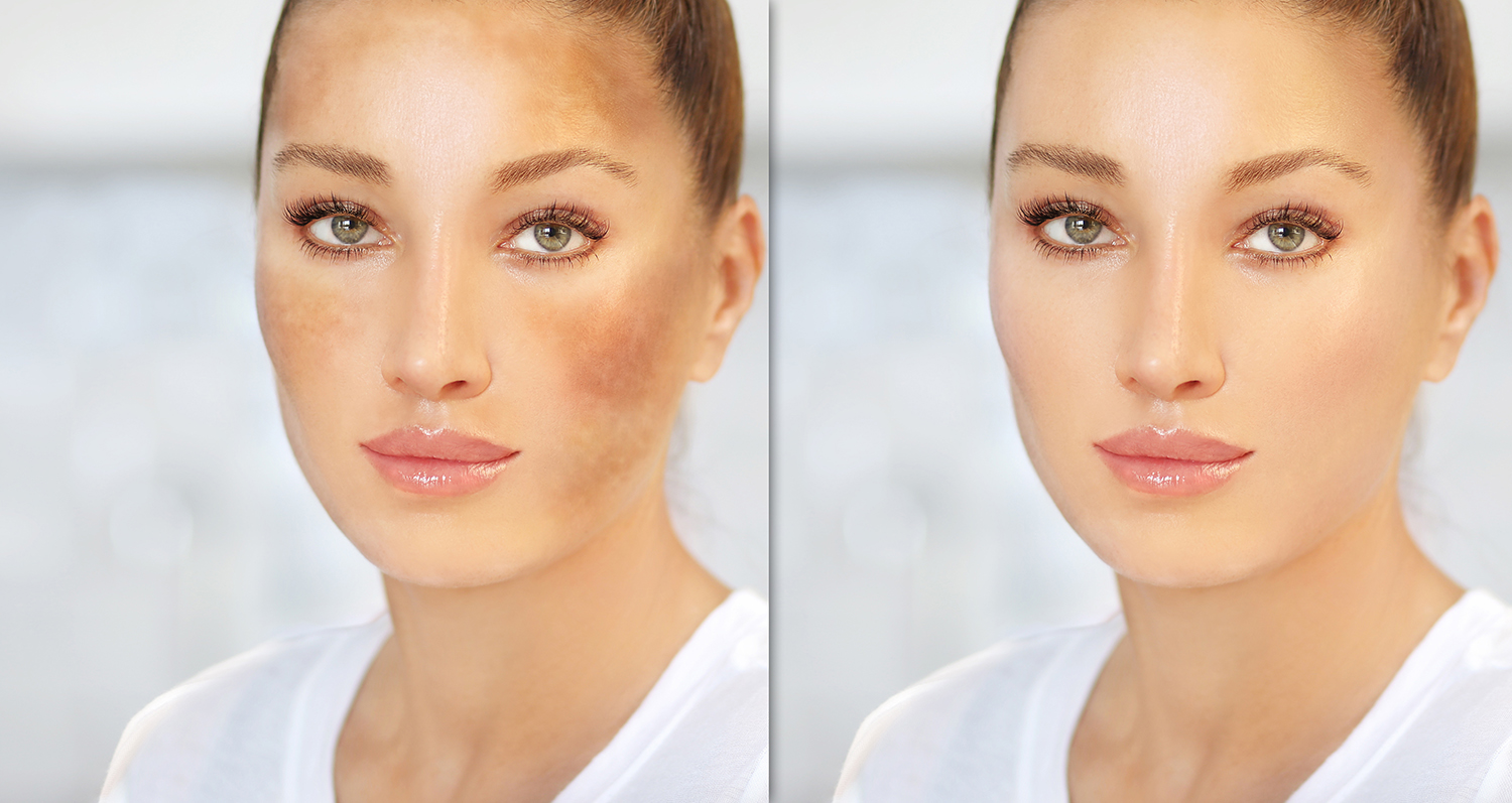 Laserowe usuwanie przebarwień – efektywna metoda na promienną i jednolitą skórę